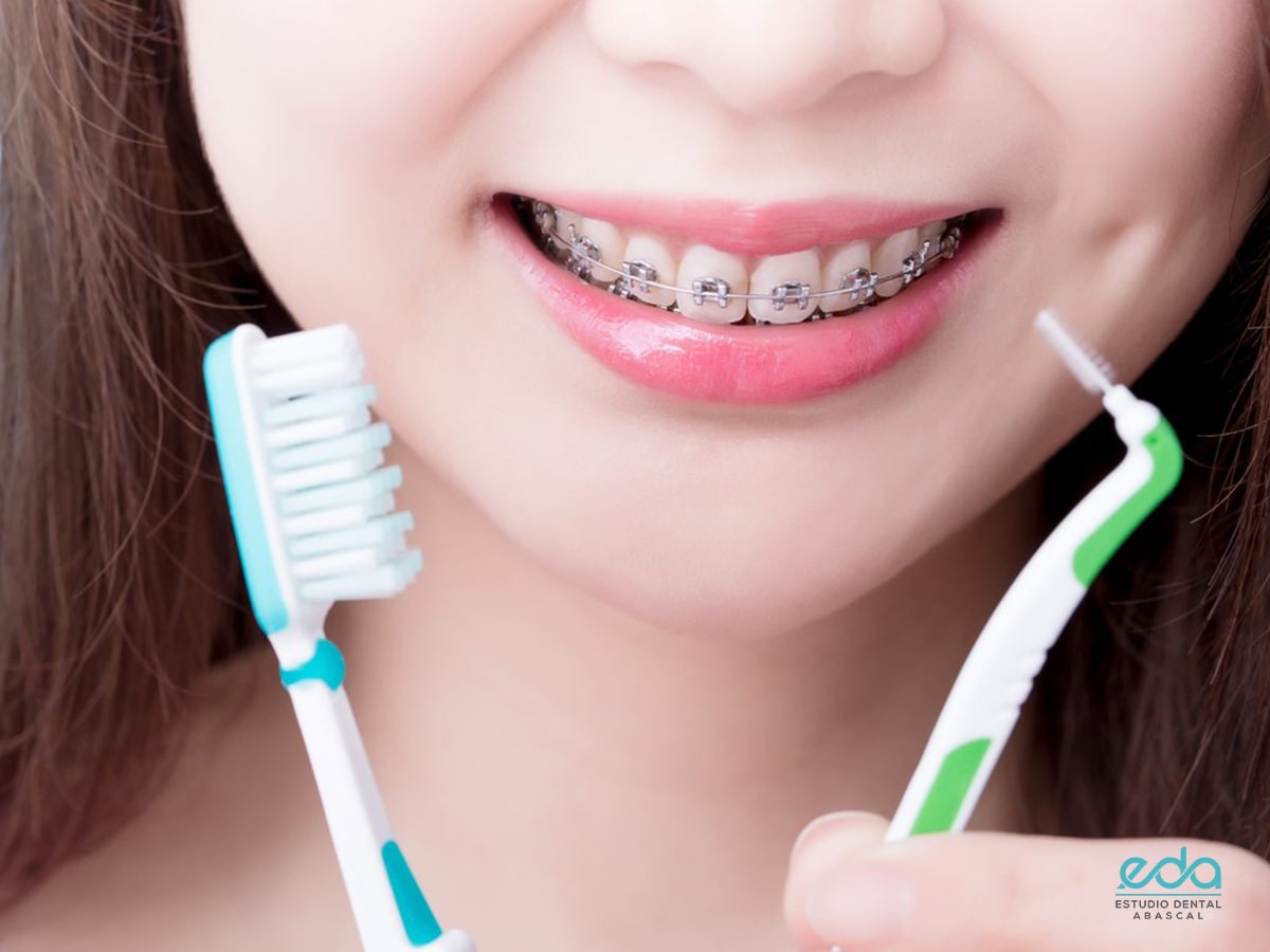 Descubre el tiempo exacto que tardan en ponerte los brackets después